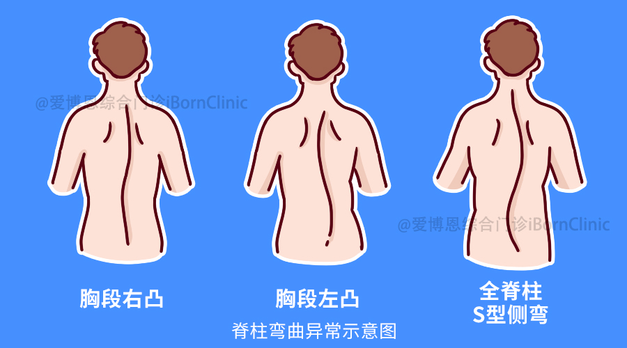 脊柱的旋转和矢状面上后突或前突的增加或减少,同时还有肋骨左右高低
